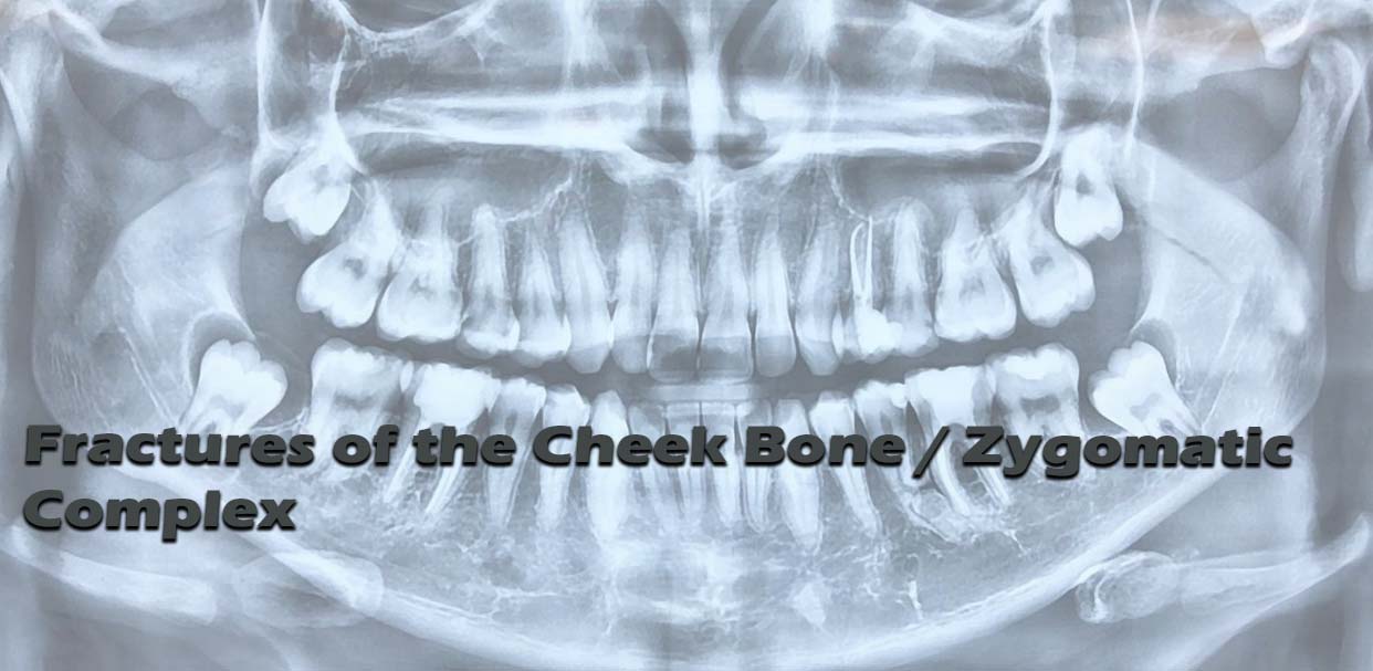 Fractures of the Cheek Bone